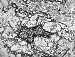 Whipple disease Whipple disease